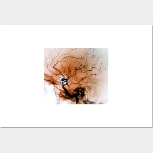 Cerebral aneurysm, angiogram (C037/0731) Posters and Art